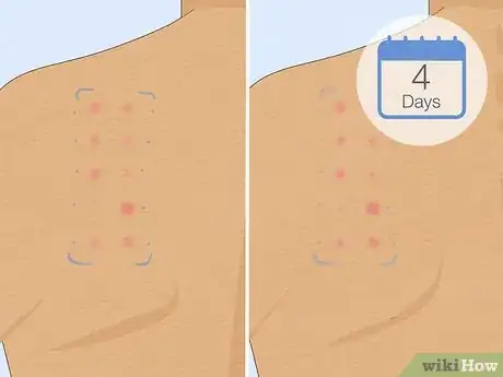 Imagen titulada Patch Test Skin Step 8