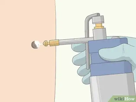 Imagen titulada Remove Moles Quickly Step 5