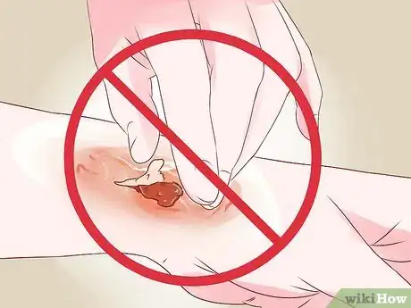 Imagen titulada Treat a Burn Using Honey Step 14
