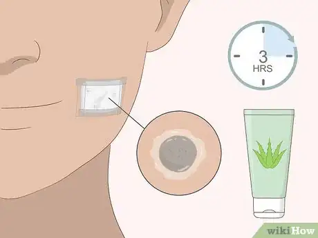 Imagen titulada Remove Moles Quickly Step 8