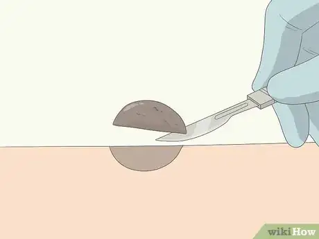 Imagen titulada Remove Moles Quickly Step 3