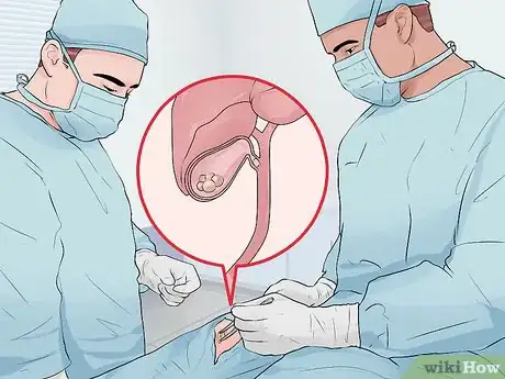 Imagen titulada Differentiate Acute Pancreatitis from Similar Conditions Step 11