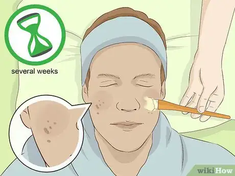 Imagen titulada Treat Idiopathic Guttate Hypomelanosis Step 6