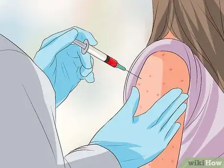 Imagen titulada Recognize Chickenpox Step 14