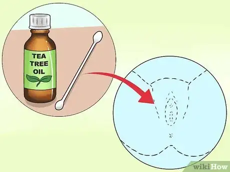 Imagen titulada Stop Vaginal Itching Step 7