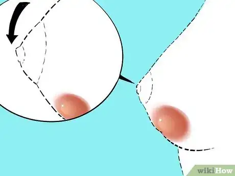 Imagen titulada Treat a Cyst Step 2