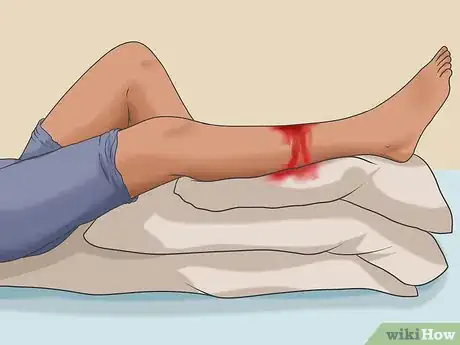 Imagen titulada Splint a Fracture of the Lower Leg Step 12