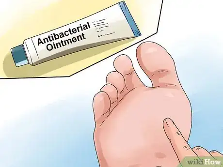 Imagen titulada Care for a Burst Blister Step 5