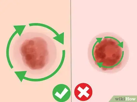 Imagen titulada Get Rid of Bruises Step 8