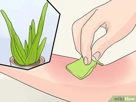Imagen titulada Treat a Blistered Sunburn Step 3