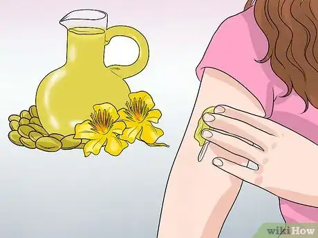 Imagen titulada Remove Keloid Scars at Home Step 11