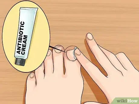 Imagen titulada Relieve Ingrown Toe Nail Pain Step 18