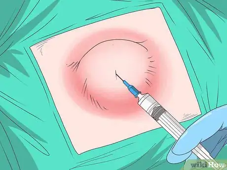 Imagen titulada Drain a Cyst Step 1