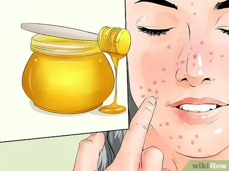 Imagen titulada Treat Chicken Pox Scars Step 8