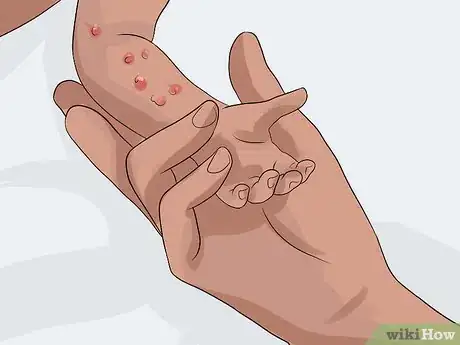 Imagen titulada Spot Meningitis in Babies Step 6
