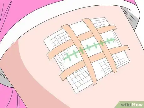 Imagen titulada Drain a Cyst Step 4