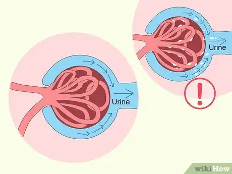 Imagen titulada Reduce Foamy Urine Step 16