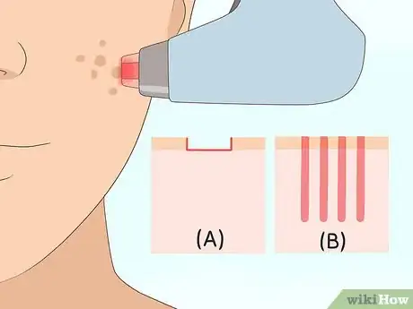 Imagen titulada Get Rid of Acne Scars Fast Step 2