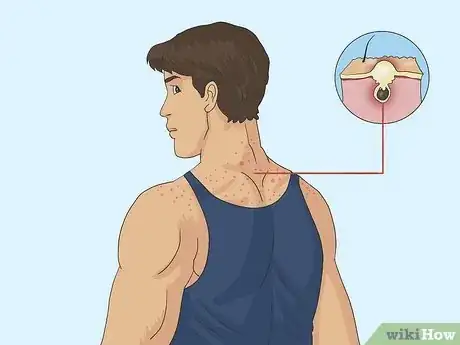 Imagen titulada Tell if Someone Is on Steroids Step 1