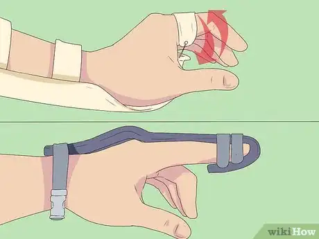 Imagen titulada Splint a Fractured Hand Step 1