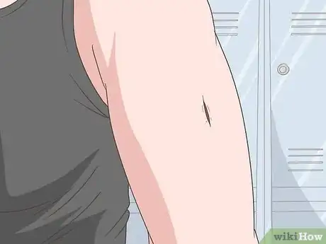 Imagen titulada Remove Glass from a Wound Step 8