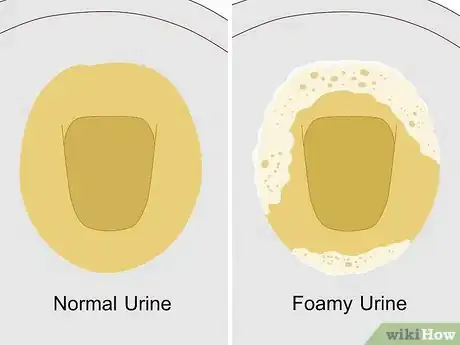 Imagen titulada Reduce Foamy Urine Step 1