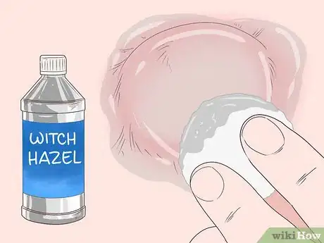 Imagen titulada Drain a Cyst Step 9