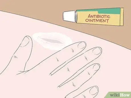 Imagen titulada Remove Glass from a Wound Step 7