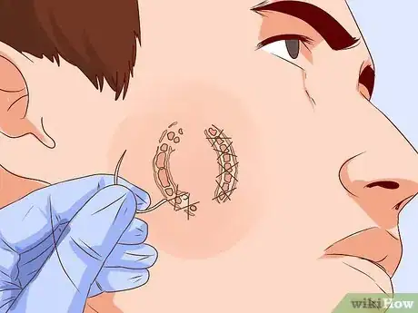 Imagen titulada Treat a Human Bite Step 10