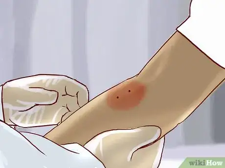 Imagen titulada Treat a Snake Bite Step 16