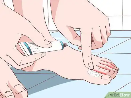 Imagen titulada Know if You Have Jock Itch Step 7