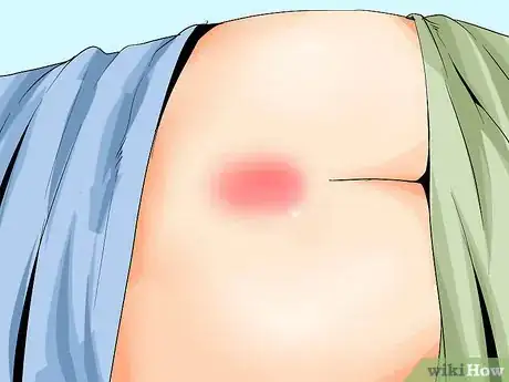 Imagen titulada Treat a Pilonidal Cyst Step 4