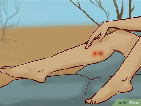 Imagen titulada Treat a Snake Bite Step 4