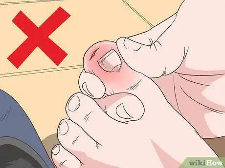 Imagen titulada Remove a Deep Splinter Step 10