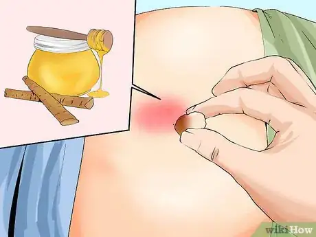 Imagen titulada Treat a Pilonidal Cyst Step 8