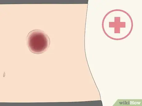 Imagen titulada Treat a Hernia at Home Step 13
