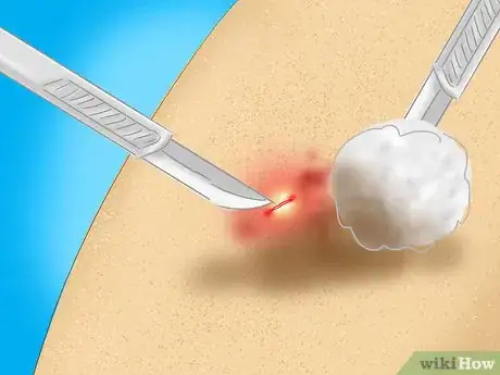 Imagen titulada Treat a Staph Infection Step 7
