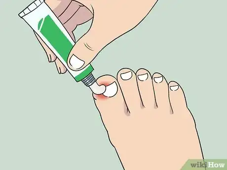 Imagen titulada Soak an Ingrown Toenail Step 5