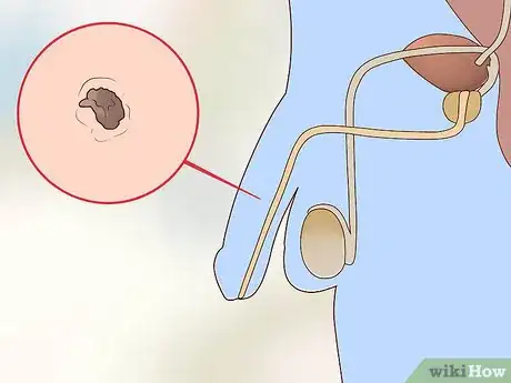 Imagen titulada Tell Signs of Sexual Infection from Penis Step 16