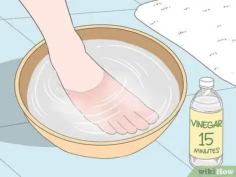 Imagen titulada Remove Splinters from Feet Step 12