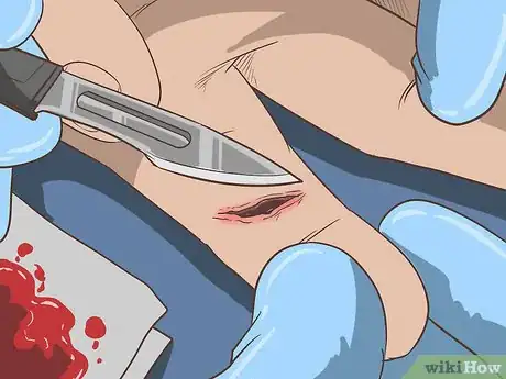 Imagen titulada Remove a Deep Splinter Step 16