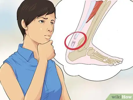 Imagen titulada Diagnose a Torn Calf Muscle Step 13