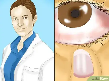 Imagen titulada Get Dirt Out of Your Eye Step 10
