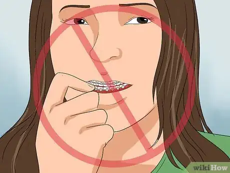 Imagen titulada Get Your Braces off Faster Step 12