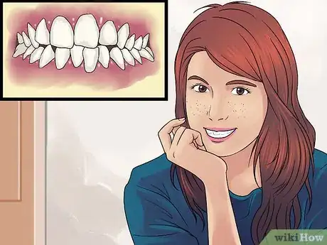 Imagen titulada Get Straight Teeth Without Braces with Invisalign Step 2