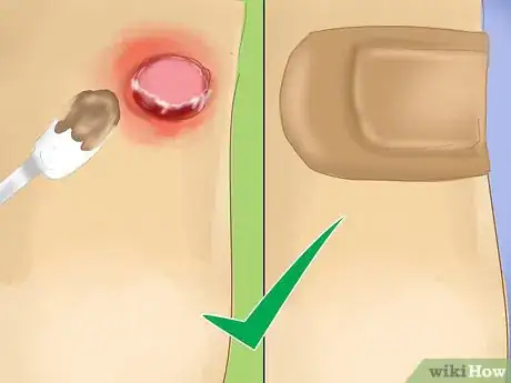 Imagen titulada Treat Raw Blisters on the Palm of Your Hand Step 5