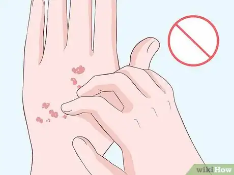 Imagen titulada Heal Scabies Scars Step 14