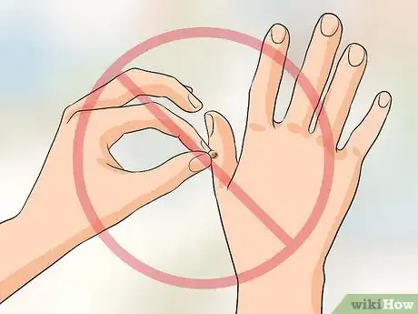 Imagen titulada Get Rid of Warts on Fingers Step 10