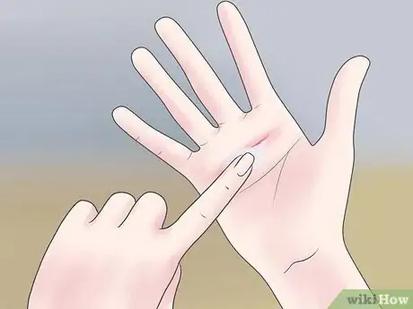 Imagen titulada Treat a Deep Scrape Step 4