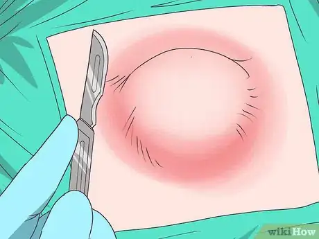 Imagen titulada Drain a Cyst Step 2